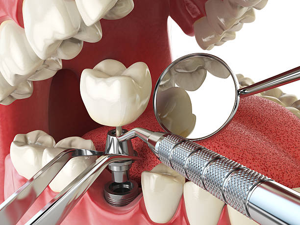 Best Emergency Tooth Extraction in Eagle, WI